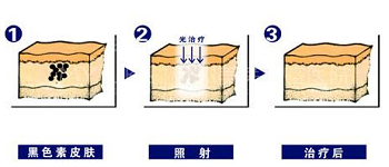 皮秒激光祛斑的原理