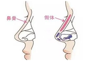 上海隆鼻用假体隆鼻