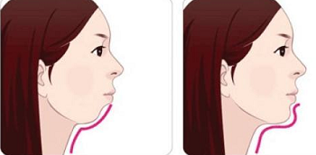 玻尿酸垫下巴效果蛮不错