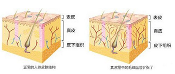 去除红血丝可以用激光