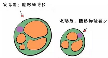 吸脂减肥不会反弹