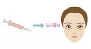 泪沟填充是怎么样的