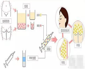 自体脂肪移植成活率瘦什么影响