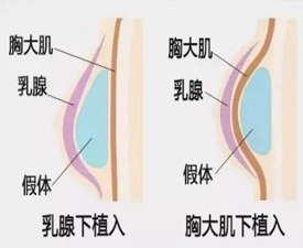 假体隆胸影响哺乳吗