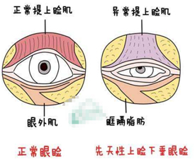 上睑下垂矫正手术效果