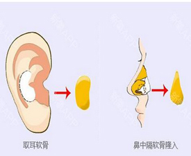 自体软骨隆鼻的方法好