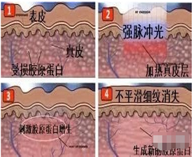 彩光嫩肤会不会让皮肤变薄