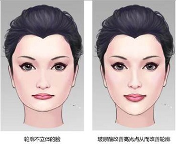鼻子和下巴对侧颜影响很重要