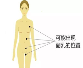 副乳是什么