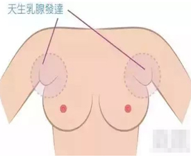 副乳是脂肪吗