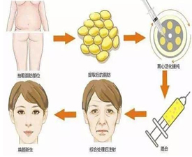 自体脂肪移植是怎么移植的