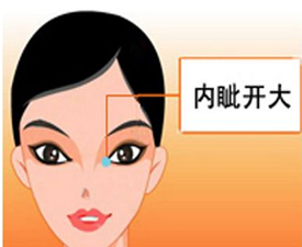 割双眼皮开眼角