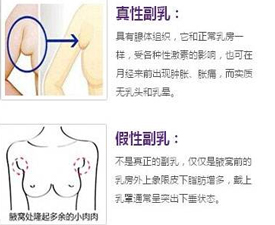 真性副乳和假性副乳是什么