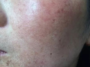 红血丝的分类类型