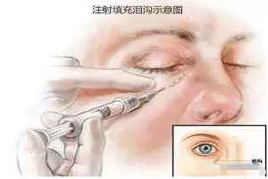 去除泪沟是用玻尿酸还是自体脂肪