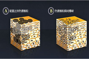 激光洗纹身为什么效果不好