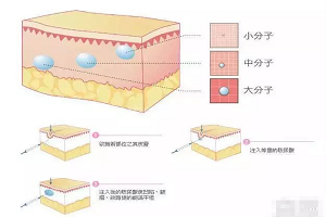 打玻尿酸都能改变什么