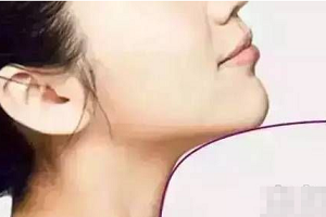 上海丰下巴的常用方法