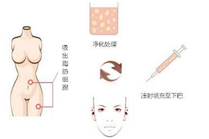 上海隆下巴的常用方法