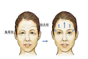 整形医院里怎么除皱的