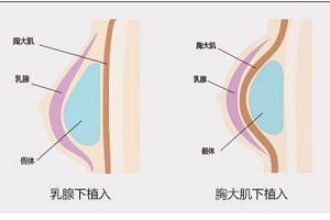 丰胸