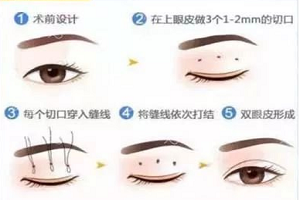 双眼皮怎么预防留疤