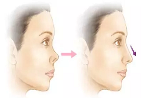 究竟什么是鼻中隔延长术?