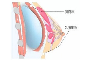 假体几年后要取出来吗