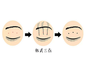 上海双眼皮失败修复怎么做的