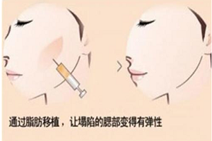 为什么自体填充面部以后显得这么老
