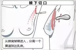 隆胸的切口