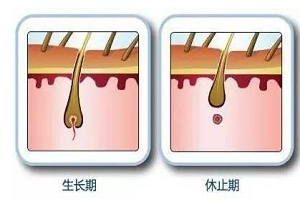 激光脱毛为什么要分很多次治疗