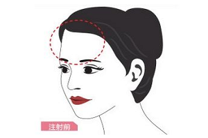 自体脂肪填充额头