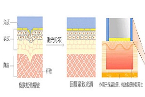 激光去鱼尾纹要多少钱