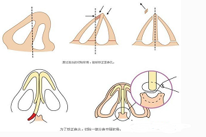 　歪鼻整形手术