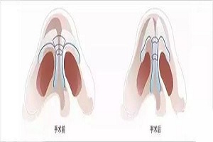 　　上海鼻形矫正怎么样?宽鼻整形