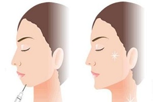 打玻尿酸下巴多少钱