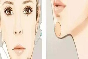 打玻尿酸下巴多少钱