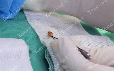 手术中去除的眼袋脂肪