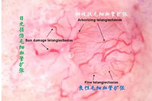 面部红血丝