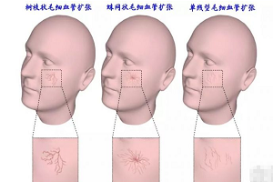 面部红血丝的类型