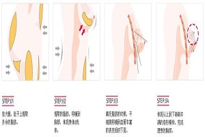 自体脂肪隆胸你了解多少呢?