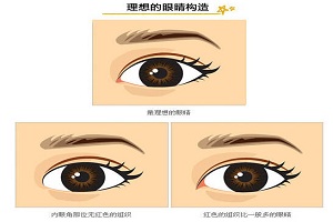 开眼角术后眼睛真的会变大吗