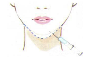 上海垫下巴有什么方法