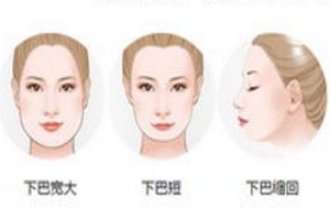 怎么样隆下巴的效果会更好