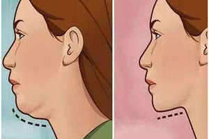 怎么样隆下巴更好