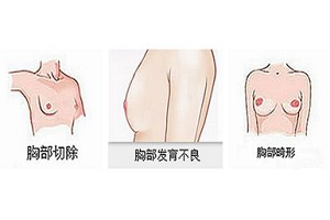 上海什么时候做乳房再造手术好