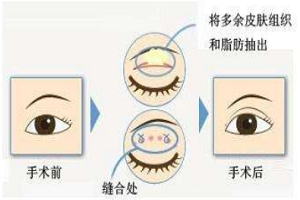 水泡眼是怎么回事?形成原因是什么?