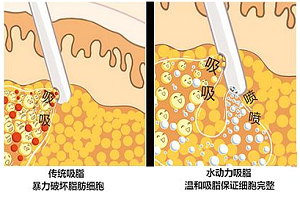 上海水动力吸脂减肥好吗?有副作用吗?