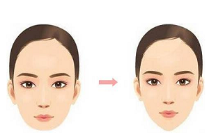 上海假体隆下巴